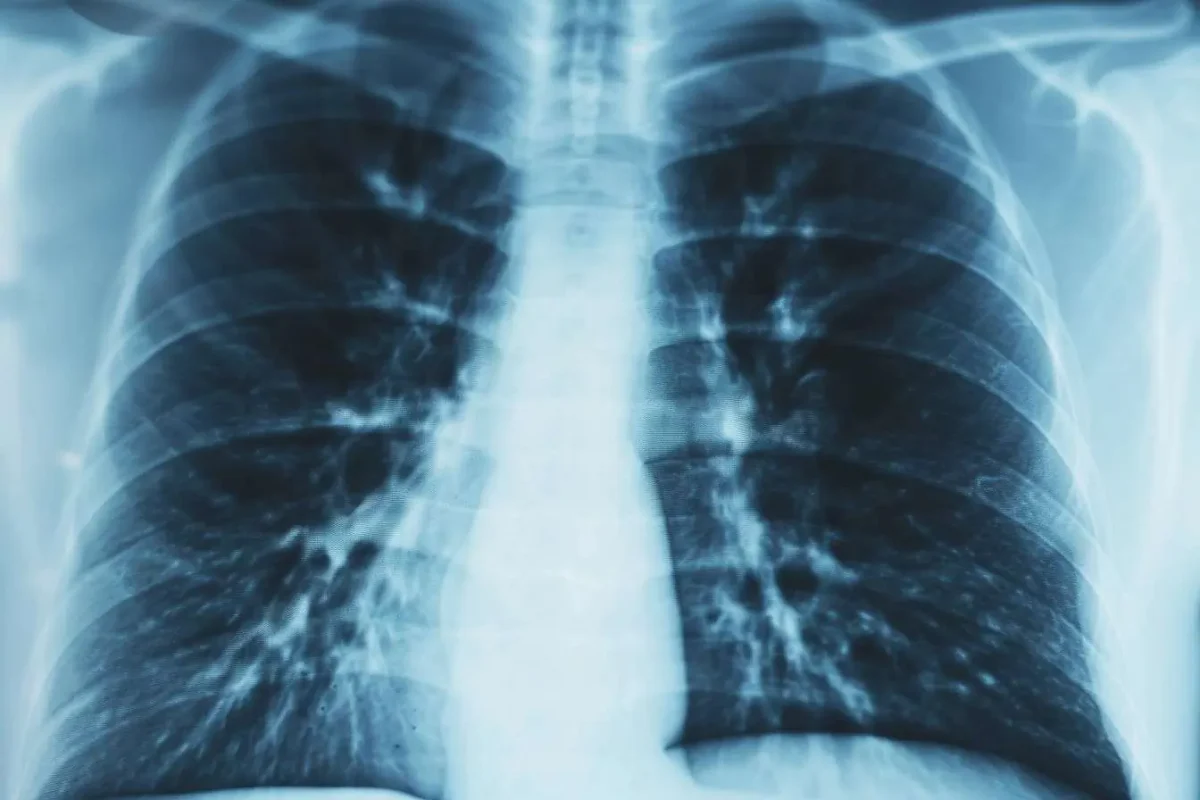 Nuevo biomarcador para detección temprana del cáncer de pulmón