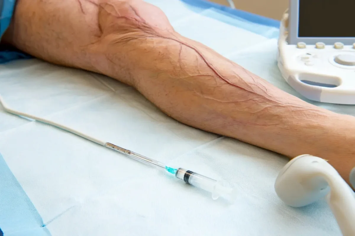 Nuevos tratamientos sin cirugía para eliminar las varices